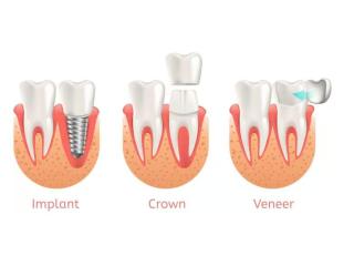 Same-Day Crowns  in Las Vegas at Functional Aesthetic Dentistry
