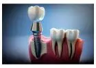 Dental Implants in Islamabad – How They Mimic Natural Teeth