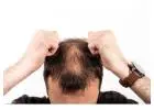 Hair fall solution for men