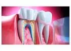 Root Canal Treatment in Islamabad