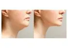 Double chin treatment in Islamabad