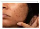 Melasma Hyperpigmentation Near you