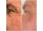 Try Fibroblast Skin Tightening Treatment by Envy Aesthetics