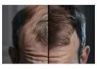 Best Solution for Thinning Hair with Personalized Treatment Care