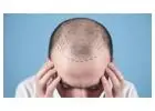 Hair Transplant in Islamabad