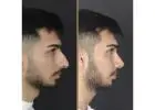Rhinoplasty in Islamabad