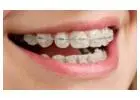 Aronson Orthodontics Clear Braces for Teeth Solutions
