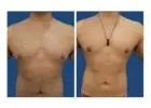 Gynecomastia in Islamabad