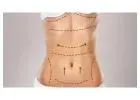 Tummy Tuck in Islamabad for Excess Fat and Skin