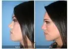Jaw Surgery in Islamabad to Enhance Facial Structure
