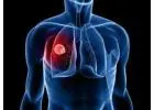 Lung Cancer Romsey
