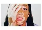 Top Dermatologists for Vitiligo Treatment in Islamabad