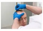 Redefine Your Look with Expert Hair Restoration